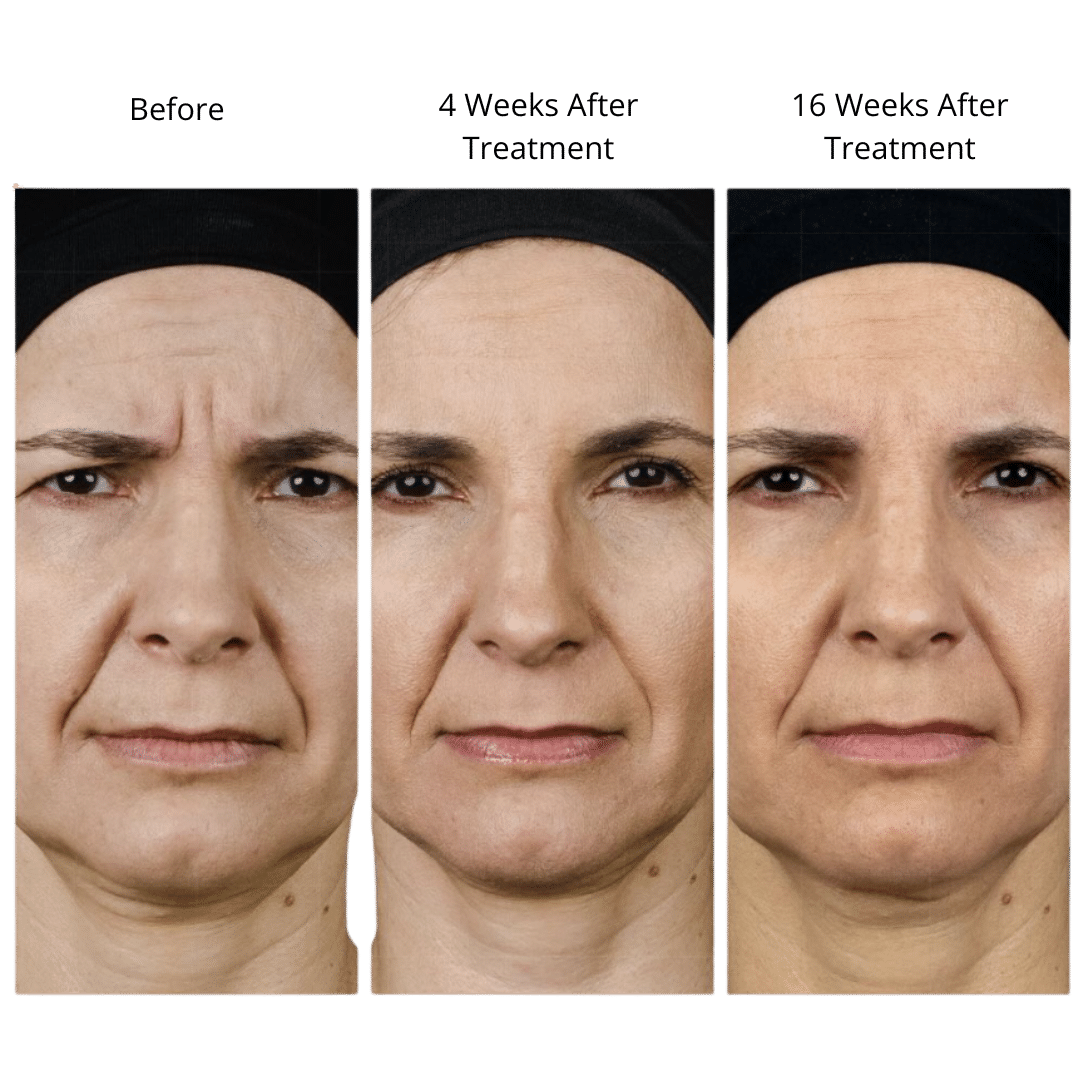 before and after letybo